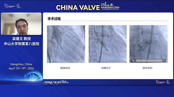 纽脉医疗亮相CHINA VALVE：SAFE原则首发引领规范，全面赋能球扩瓣技术发展